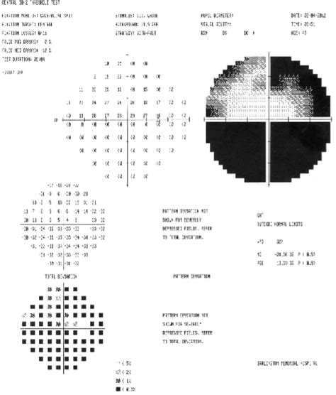 david clulow home visual field test